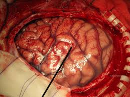 brain-surgery