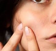 Top 25 Tips For Treatment of Acne & Pimples at Young Age